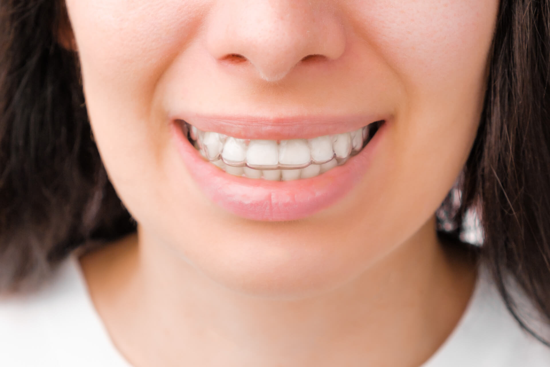 Eine lächelnde Frau mit einer kaum sichtbaren Zahnschiene im Mund.